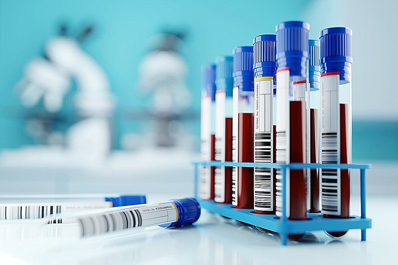 Multiple blood collection tubes with blue caps and red liquid samples arranged in a blue rack, with one tube lying separately in the foreground, set against a blurred laboratory background.